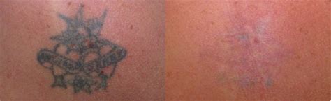 enlighten™ III by CUTERA® Laser Tattoo Removal Treatment in Midtown