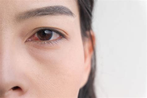 Understanding And Managing Dry Eyes During Pregnancy