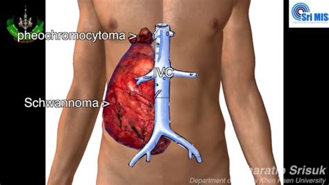 Resection Of Huge Retrocaval Schwannoma And Pheochromocytoma