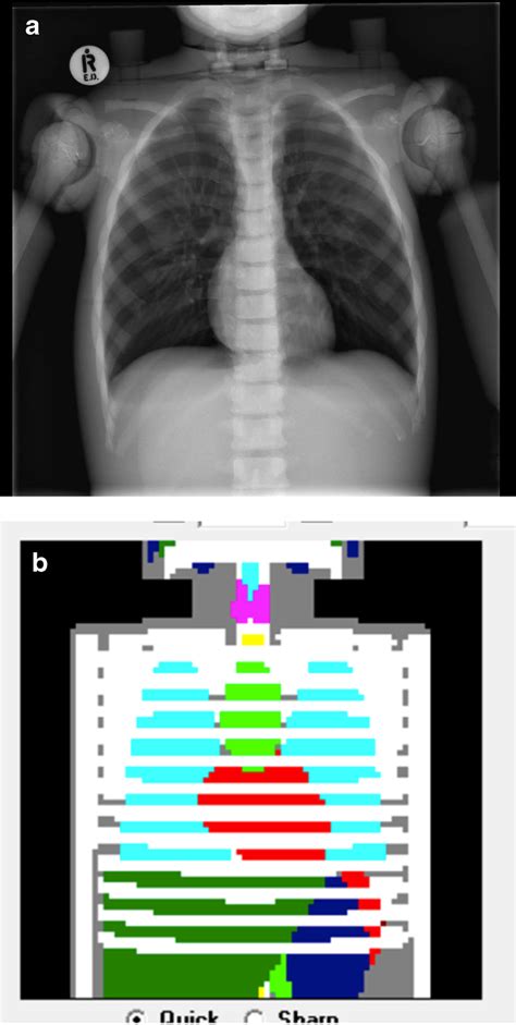 A An Antero Posterior Ap Chest Radiograph Of The Phantom Obtained