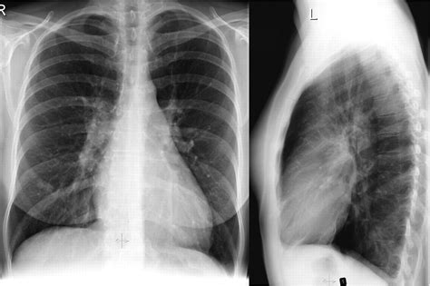 Unusual Complication With Transcatheter Closure Of An Atrial Septal