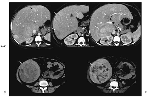 Liver Cell Adenoma Ultrasound