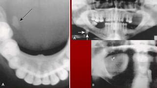 Salivary Glands Disorders | PPT