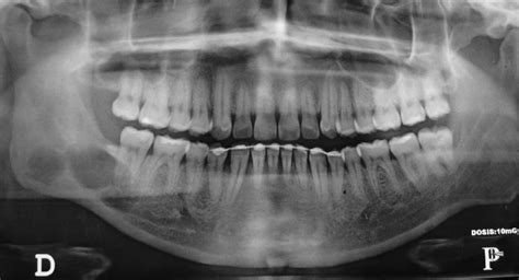 A Panoramic Radiograph Showing A Multilocular Radiolucent Lesion At The