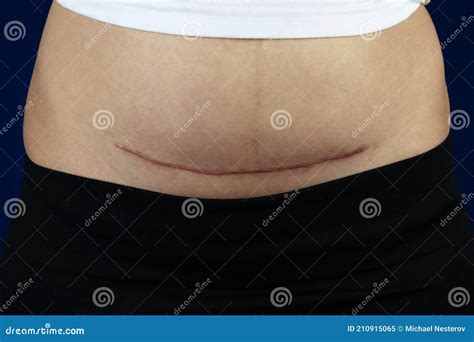 Woman Belly With A Scar From A Cesarean Section Close Up Royalty-Free ...