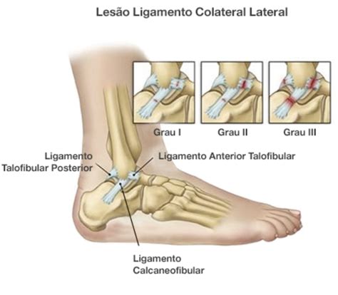 Como Saber Se Rompeu O Ligamento Do Tornozelo - Rompi os Ligamentos do Tornozelo. O Que Devo Fazer?