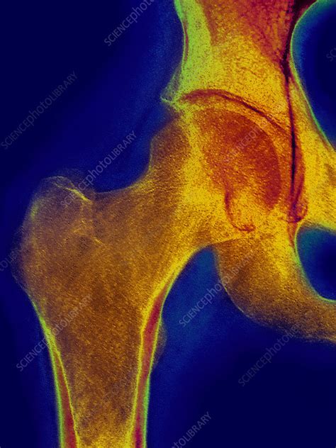 Normal Hip X Ray Stock Image C027 2177 Science Photo Library