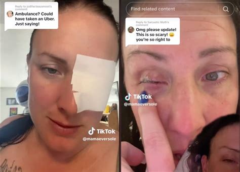 Woman Glues Eye Shut After Mistaking Glue Bottle For Eye Drops