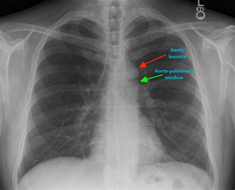Normal Chest Film 5