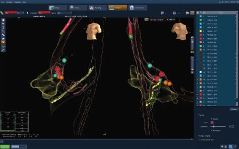 Simplified Three Dimensional Electroanatomical Mapping In LAO 30 And