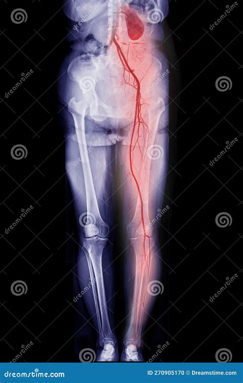 Cta Femoral Artery Run Off Showing Femoral Artery For Diagnostic Acute