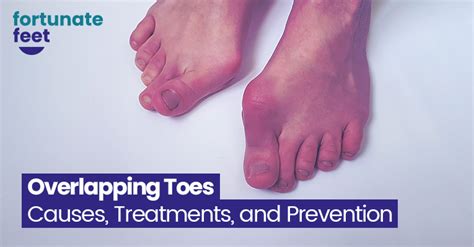 Overlapping Toes - Causes, Treatments, and Prevention - Fortunate Feet