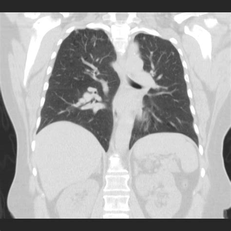 Pulmonary Langerhans Cell Histiocytosis Early Phase Image