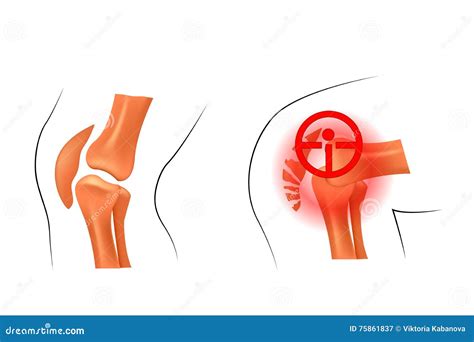 Knee Dislocation Fracture Traumatology And Orthopedics Stock Vector