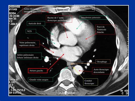 PPT Scanner Thoracique Anatomie Du Thorax En Coupes PowerPoint 496