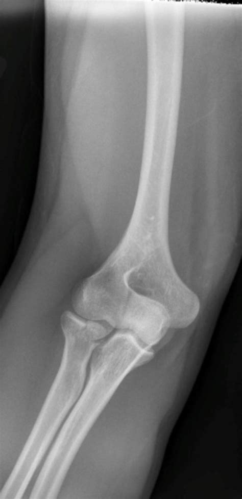 Elbow Fractures – Undergraduate Diagnostic Imaging Fundamentals