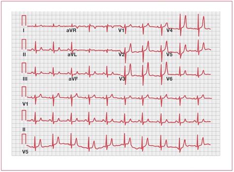 Hyperkalemia — Medlibes: Online Medical Library