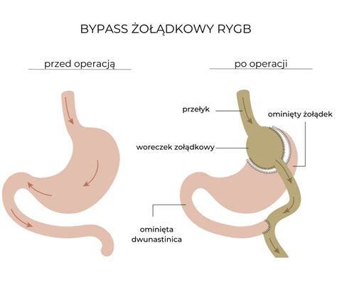 R Kawowa Resekcja O Dka Dermedik Krak W