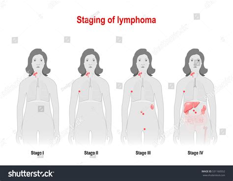 Staging Lymphoma Cancer Lymphatic System Signs Stock Illustration 531160552