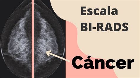 O Que Significa Acr Bi Rads 2 BRAINCP