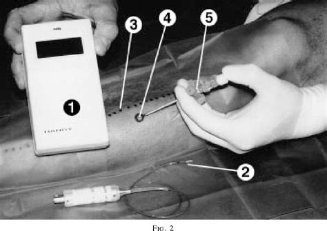 Figure 2 From Electronic Transducer Tipped Catheter System Measurement Of Intracompartmental