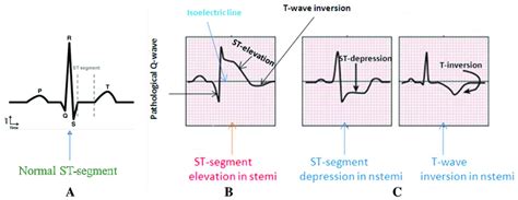 STEMI ST Elevation Myocardial Infarction Diagnosis