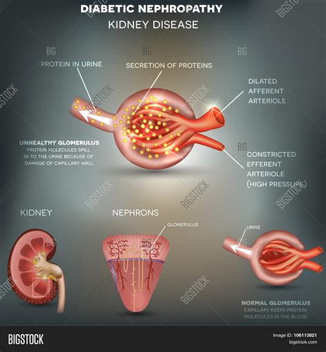 Diabetic Nephropathy Vector And Photo Free Trial Bigstock