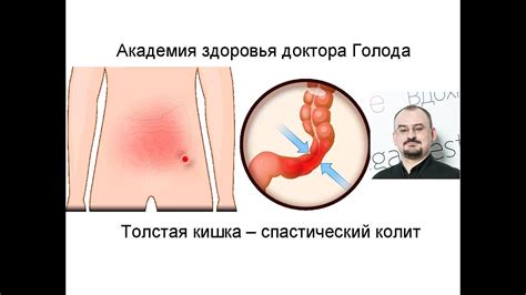 Толстая кишка. Спастический колит. - YouTube