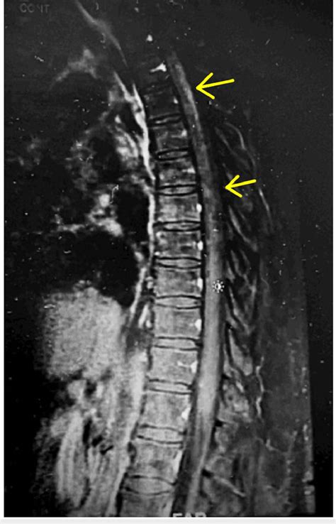 T1 Weighted Thoracic Spine Mri Post Contrast Arrows Denoting Download Scientific Diagram