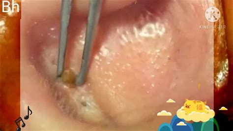 BIGGEST Blackhead Removal Videos 2019 Large Blackheads Removal Best