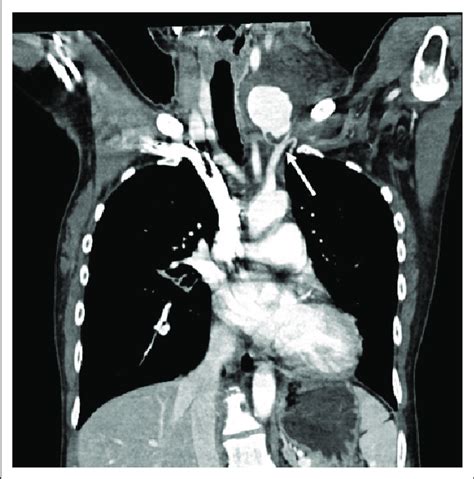 The Chest Computed Tomography Download Scientific Diagram