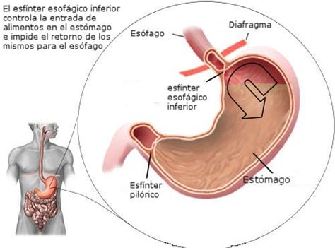 Reflujo Gastroesof Gico S Ntomas Causas Y Tratamiento Md Sa De