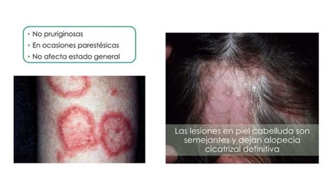 Lupus Eritematoso Discoide PPT