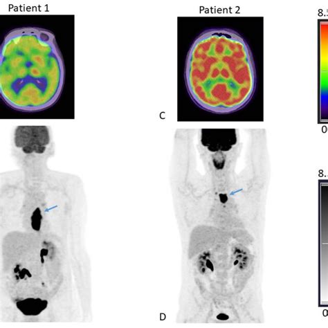 F Fdg Fused Pet Ct Axial Slices Passing Through The Brain A C And