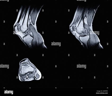 Magnetic Resonance Imaging Mri Of Right Knee Closed Injury Of The