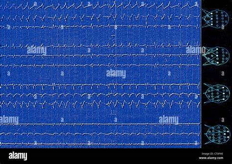 Creutzfeldt Jakob Disease Eeg Hi Res Stock Photography And Images Alamy