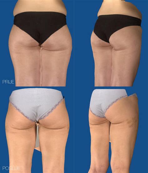 Vaser Liposuction How To Get Natural Results With Ultrasound Assisted Liposuction Intechopen