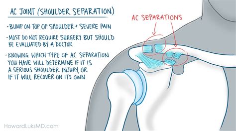 Serious Shoulder Injuries When Should I See A Doctor