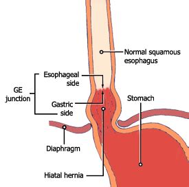 Hiatus Hernia