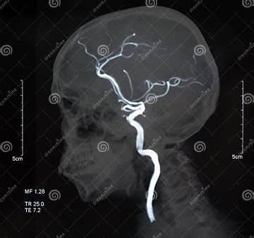 Mri blood vessels stock image. Image of angiogram, aneurysm - 288131251