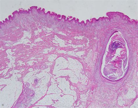 -A 1-year-old infant with nevus lipomatous cutaneous superficialis ...