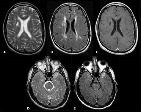 Image Bank: CADASIL MRI