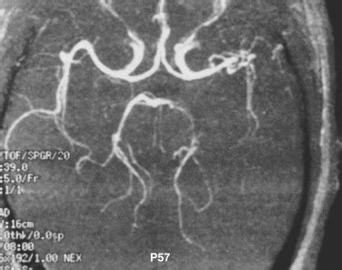 Cerebral Infections And Inflammation Radiology Key