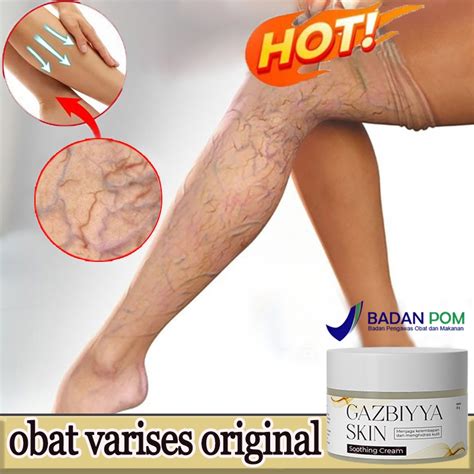 Jual Salep Varises Paling Ampuh Original Valesin Obat Varises Original