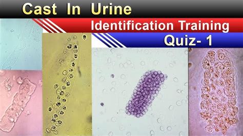 Rbc Cast In Urine