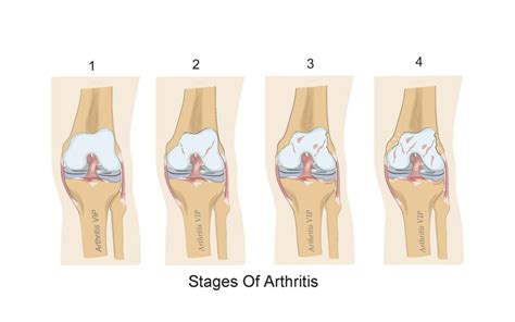 Stages Of Arthritis Arthritis Vip Dr Mark Hawass