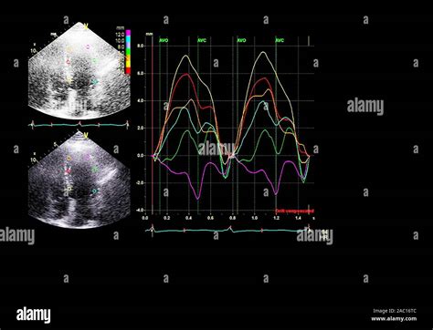 Screen of an ultrasound machine with a heart image Stock Photo - Alamy