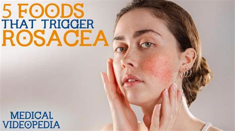 Most Common Foods That Cause Rosacea Youtube