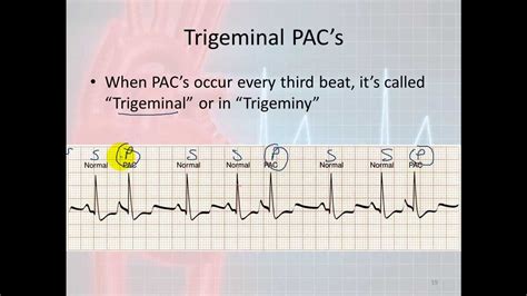 Basic Electrophysiology Part 7 Atrial Rhythms Part 1 Introduction