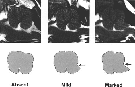 Method Of Scoring The Deformity Of The Cerebellum Observed In Magnetic